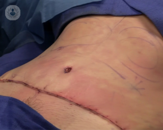 Operación de abdomen para conseguir un vientre plano