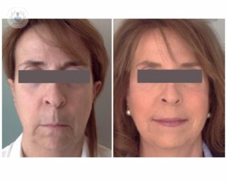 Técnicas y tratamientos para realizar un rejuvenecimiento facial