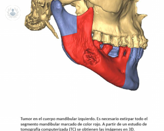 reconstruccion facial tumor mandibular con tecnologia 3D