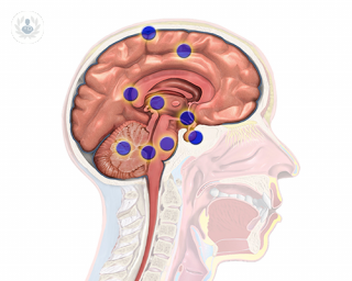 regiones tumores cerebrales