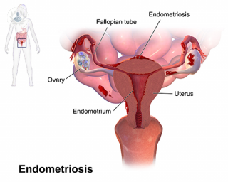 dibujo endometriosis