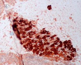 melanoma maligno visto al microscopio