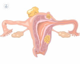 dibujo mioma uterino