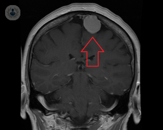 radiografia meningioma