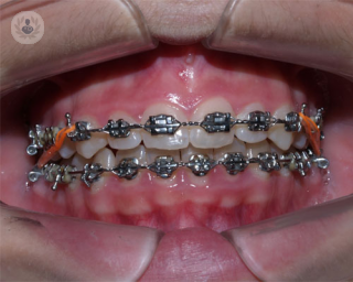 ¿Qué ortodoncia es la más adecuada para mi hijo?