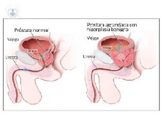 Los problemas de micción pueden ser síntomas de una hiperplasia de próstata, el doctor Peinado explica que hacer entonces y cómo se trata esta patología. 