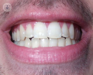 La bioestética soluciona con éxito los casos de desgaste dental que son erróneamente clasificados como bruxistas. También es adecuado este modelo terapeútico para 