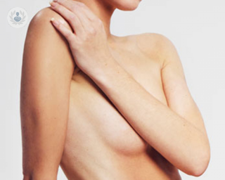 Las prótesis anatómicas de alto perfil son las más apropiadas para corregir mamas tuberosas