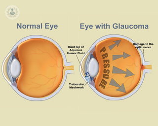 como saber si tengo glaucoma