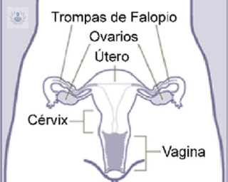 El quiste de ovario supone un problema, ya que puede dar lugar a un tumor. Se debe tratar o con medicación o mediante la extirpación quirurgica