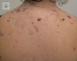 acne_cicatriz_dermatologia_piel_tratamiento_crema_juvenil