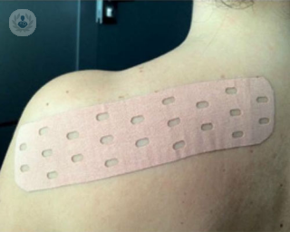El Punch Tape es una técnica de vendaje neuromuscular que ha demostrado ser útil para tratar el linfedema 