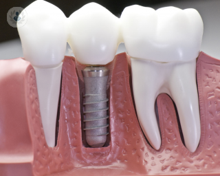 implantes, dentales, dentista, ortodoncia, implantes dentales,