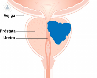 El cáncer de próstata es la patología cancerígena más frecuente en el varón. 
