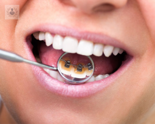 La ortodoncia lingual es una ortodoncia fija con la diferencia que los brackets van en la cara interior de los dientes 