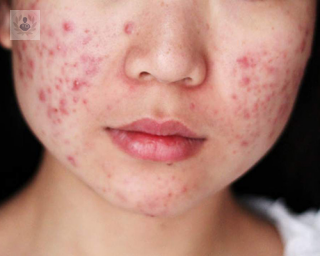 problemas de acne, tratamiento de acne, consejos para el acne, sintomas de acne