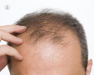 el hombre calvo que padece alopecia, problemas capilares