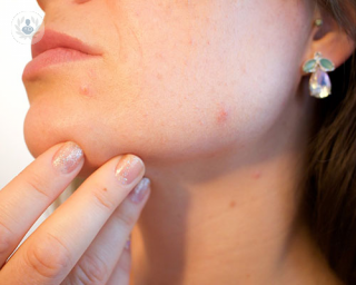 causas del acne adulto