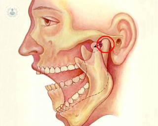 Está indicada para corregir una alteración en el desarrollo de los maxilares.