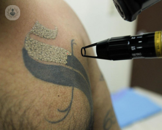 Rayo laser para quitar tatuajes