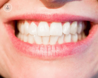 implantes_dentales_implantologia_dientes_sonrisa