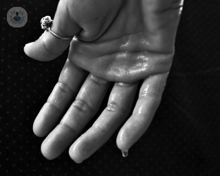 La hiperhidrosis suele afectar de manera más común a las palmas de las manos