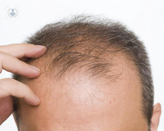 La alopecia afecta principalmente a hombres, alrededor de un 40%