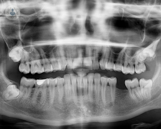 Para evitar estos problemas, es importante reponer los dientes perdidos con una prótesis dental lo antes posible