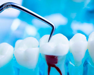 Si la conservación del diente es viable, es mejor realizar la endodoncia