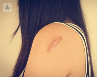 cicatriz mujer hombro tratamiento topdoctors