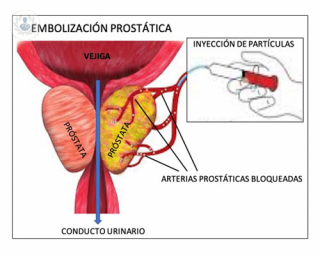 La embolización prostática es un tratamiento no quirúrgico para la hiperplasia benigna de próstata