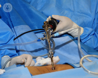 discectomía endoscópica para hernia discal lumbar by Topdoctors