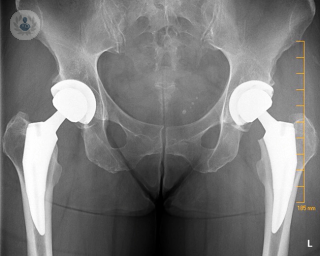protesis de cadera radiografia