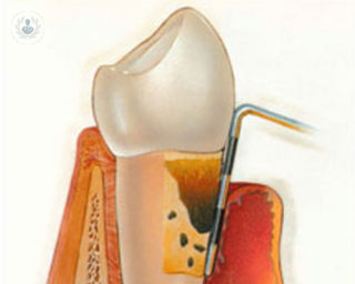 Periodoncia y enfermedad periodontal