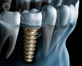 implantes dentales de cerca