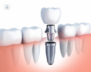 implante_dental_osteoporosis_prodentis