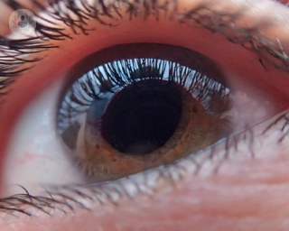 Un glaucoma es una enfermedad ocular