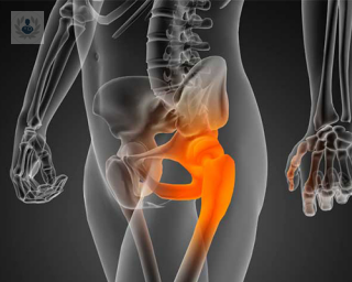 Las operaciones de cadera pueden deberse a desgaste, mala alineación de los huesos o lesiones.