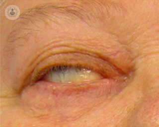 Puede afectar a cualquier músculo, pero lo más frecuente son los músculos oculares
