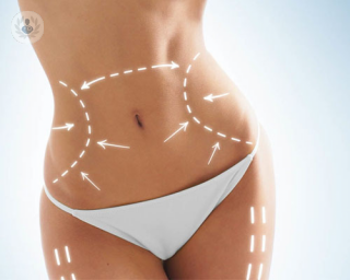 La liposucción permite eliminar la grasa de determinadas zonas del cuerpo