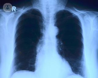Screening de cáncer de pulmón