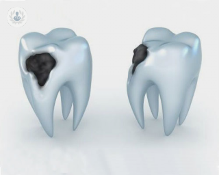 caries dientes sintomas