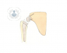 Descubre la aplicación de las prótesis de hombro dependiendo de la dolencia y las necesidades del paciente.