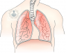 Cirugía de bronquiectasias