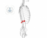 La estenosis de canal es la disminución de los diámetros del canal llumbar donde se encuentran la parte fina de la médula espinal y lar raíces de los nervios de cola de caballo.