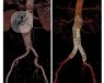 El doctor García-Madrid nos cuenta qué es y de qué manera se trata el aneurisma de aorta, un ensanchamiento localizado de la arteria aorta.