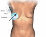 protesis mamaria
