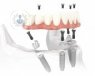 Implantes dentales de carga inmediata: beneficios y riesgos