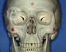 La cara está formada por huesos que no siempre pueden absorber un impacto. Entonces produce una fractura. El Dr. Ots Feliciano te informa