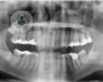 El Cáncer Oral puede afectar a cualquier estructura de la cavidad bucal.